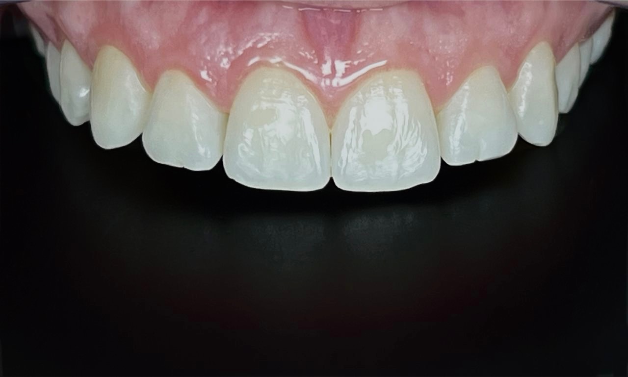 Clareamento — Resultado de clareamento — antes e depois