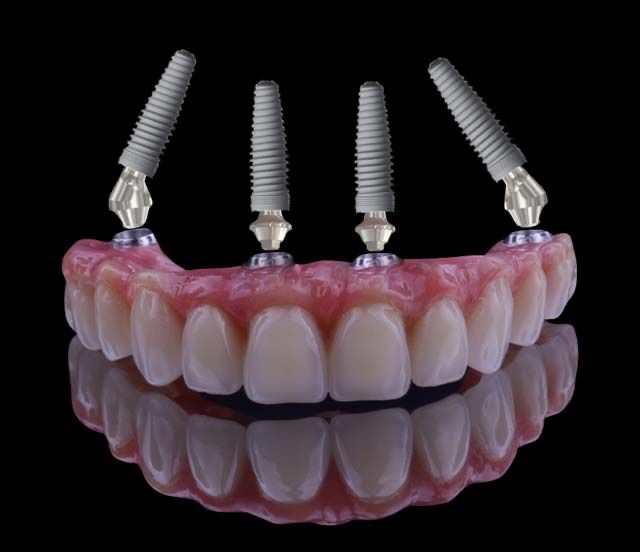 Implantes — Dr. Daniel Francês