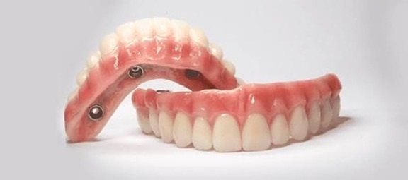 Implantes — Reabilitação fixa sobre implantes