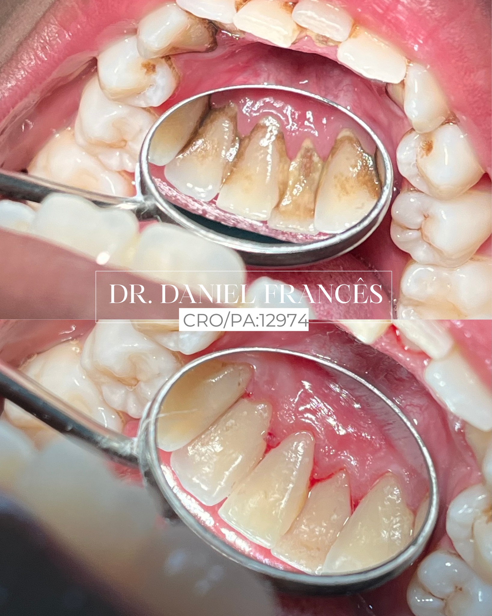 Limpeza e Prevenção — Antes e depois da remoção de tártaro
